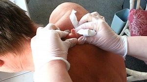 Thirty-year-old cyst gets drained