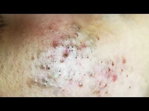 2024's Mind-Blowing Extreme Blackhead Removal