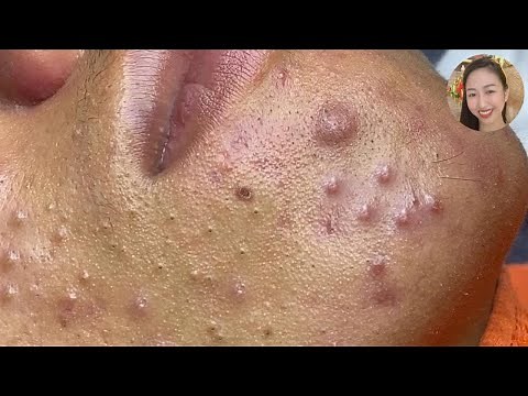 Acne Treatment 2021 - Relaxing With Blackhead Removal Videos #26