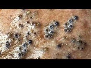 Best Blackhead Removal #005 - Facial Acne Treatment - Gà Spa