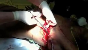 Emergency Department Thoracotomy For Stabbed Heart 2006