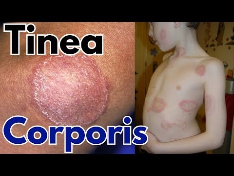Tinea corporis infection | Ring worm symptoms, treatment and causes