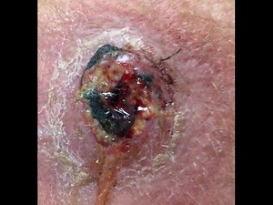 Spider Bite or Staph Infection? MRSA? How Did This Happen?