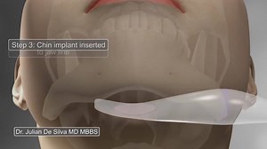 #Chin augmentation with implant is a popular surgical intervention that is performed to create more prominent and define chin projection, remove double chin appearance and create more balanced symmetrical facial feature. Incision is generally placed either under the chin on in the pocket created inside the lower lip and then positioned with a small screw or kept in place by the tissue itself. Chin implant surgery is very popular for both female and male patients and can complement another orthod