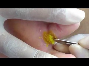 Verruga plantar