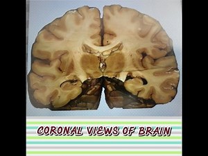 Brain Anatomy (Neuroanatomy) - Coronal Sectional Views