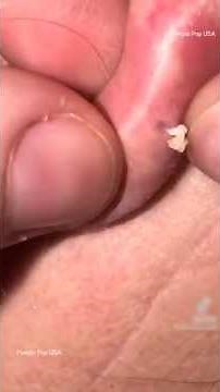 Most Satisfying Pimple Popping Compilation 2026