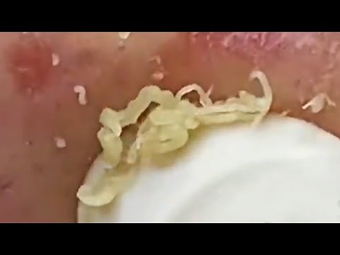 Deep blackhead extraction Cystic acne & pimple popping #82