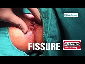 FISSURE - HOW IT LOOKS LIKE ?