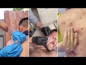Best Satisfying Pimples Popping Cyst Removal Acne Blackheads Explosive Compilation Videos #15