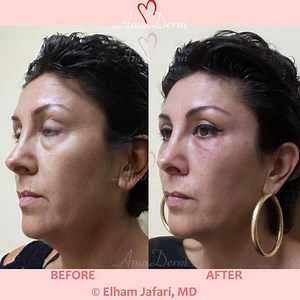 👁 4D Under Eye Lift™ as part of non-surgical facelift (Liquid Facelift) _____________________ 💉 Procedure: Injection of dermal fillers in the cheeks and under the eyes performed by experienced MD _____________________ 🎯 Purpose: Reducing the appearance of dark circles and bags under eyes, reconstruction and lifting the cheeks and removal of wrinkles and folds across the face as part of a whole-face rejuvenation approach with balanced and natural looking results without surgery and down-time _