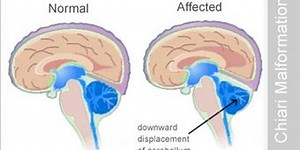 CIRURGIA SECÇÃO DO FILUM TERMINALE - ALESSANDRA ESCÓSSIO