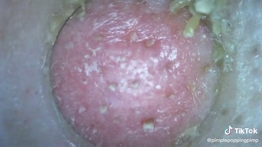 #fyp #gross #nasty #pimple #pimplepopping #porevacuum #pores #acne #porecleanse #acnecheck #blackheads #whiteheads #pimples