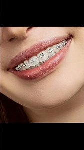 This is how to fix a crossbite