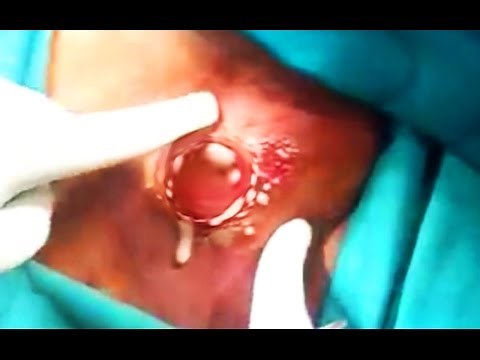 Massive Cysts, Boils and Furuncles; What is a Carbuncle?