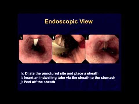 S079 A new procedure of esophagostomy for endoscopic surgeons - SS14: Therapeutic Endoscopy