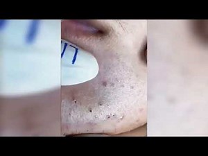 Satisfying Pimple Popping Splinter Blackhead Removing Tiktok compilation