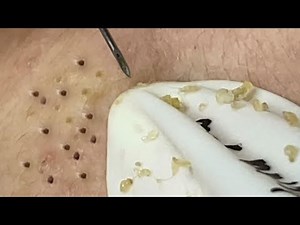 Loan Nguyen Acne Treatment (#118)