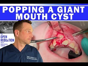 POPPING a GIANT MOUTH CYST | #cystpoping