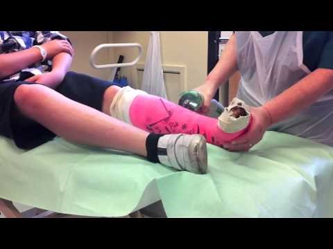 broken foot cast removal