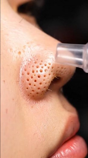 INSANE Nose Blackhead Removal with Metal Tool | Deep Pore Clean