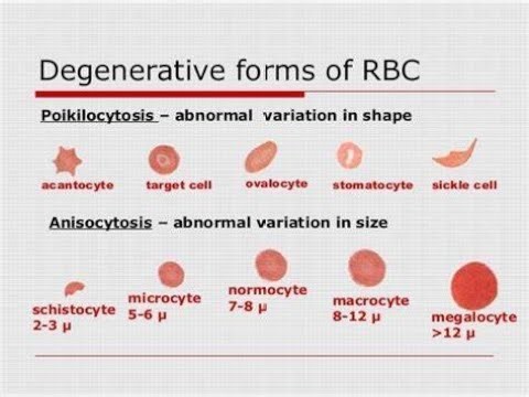 Variation in the shape of red blood cells; Crenation, spherocytosis, Elliptocytosis, sickle cell, Po