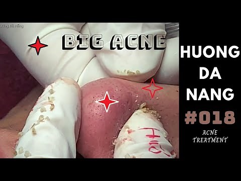 #018 | Super BIG acne all over the face | Mụn siêu to khắp mặt | Hương Đà Nẵng | akne Behandlung