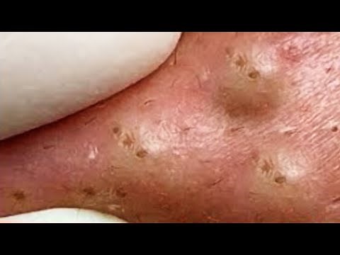 Extraction profonde des points noirs Acné kystique et popping #33