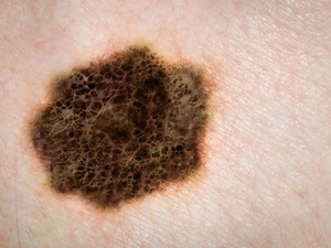 転移性黒色腫：原因、症状、および治療 - Melanomaskinがん 2026