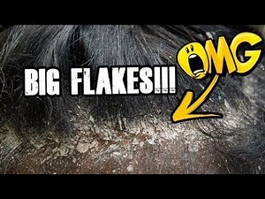NEW 2024 DANDRUFF Scratching Video//What is your favorite part?