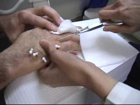 K-wire Removal from Healed Hand