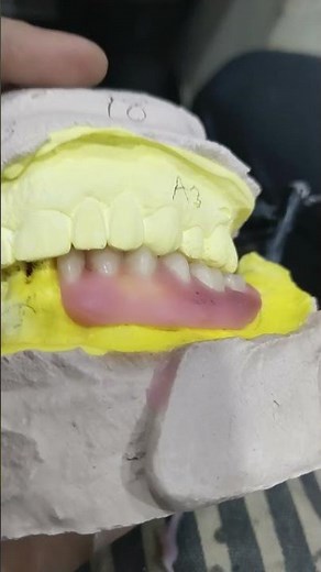 Teeth Arrangement Of Lower Flexible Partial Denture 😁😁😁