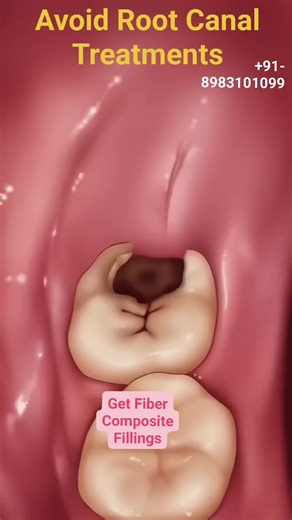 Avoid Root Canal Treatments #rootcanaltreatment #rootcanaltruths #rootcanalspecialist | Dr.Mathesul Invisalign Orthodontist Braces & Dental Implant Clinic