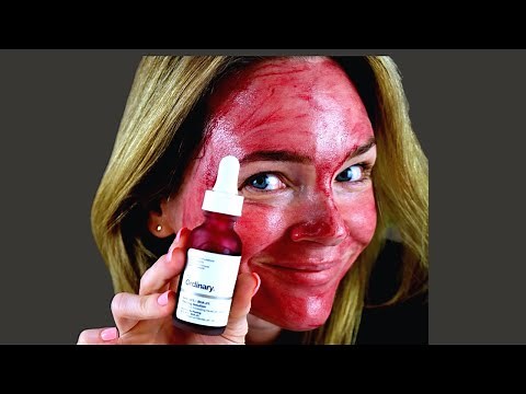 The Ordinary Peeling Solution Before and After