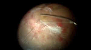 En Bloc Removal of Fibrovascular Tissue in Severe Tractional Retinal Detachment - Eyetube