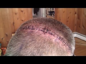 How to remove surgical staples | Surgical Staples