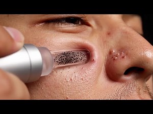 Blackhead Removal with Precision Tools | Realistic Deep Detail
