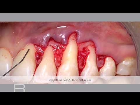 Treatment of gingival recession with a Coronally Advanced Flap by Prof Andrea Pilloni
