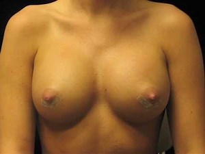 Breast Implant Massage