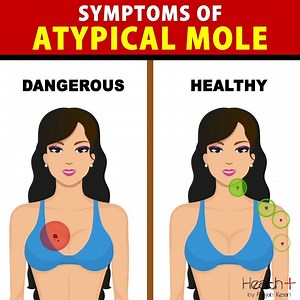 Symptoms of Atypical Mole | Health