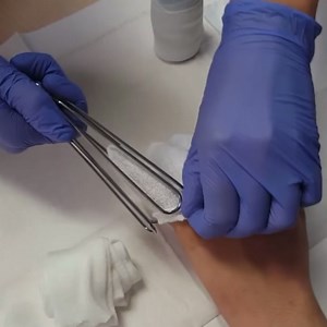 Applying finger stockinette using the dressing applicator. This is a fast and easy technique for applying finger dressing. . #handtherapy #handtherapypartners #handtherapyacademy #woundcare #hand #cht #certifiedhandtherapist #ot #pt | Handtherapyacademy