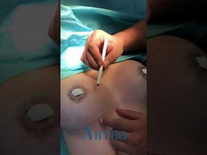 Komplett submuskuläre Brustvergrößerung mit innerem BH