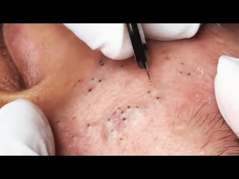 ENJOY YOUR DAY WITH GA SPA PART III #relaxing #blackheads