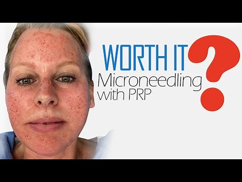 Microneedling With PRP | Vampire Facial
