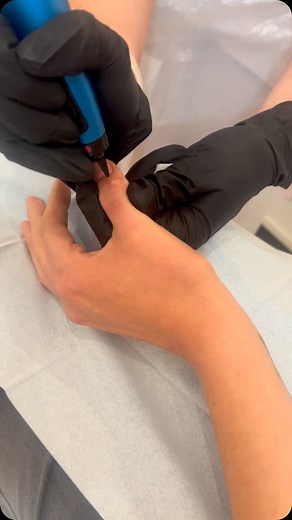 Warts be gone! 👋 Say goodbye to unwanted skin lesions with our quick and effective CryoPen treatment ❄️ This precise, non-invasive procedure uses freezing technology to remove warts, skin tags, and other benign lesions with minimal discomfort and no downtime. Ready for smooth, clear skin? Book your CryoPen session today! #CryoPen #WartRemoval #SkinTagRemoval #ClearSkinJourney #SkinClinic #Cryotherapy #WartsBeGone #SkinConfidence #NoMoreWarts #SmoothSkin #SkincareTreatment #CryoPenTreatment #Non