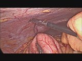 Laparoscopic Resection of Ileal Neuroendocrine Tumor • Video • MEDtube.net
