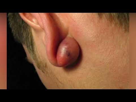 Ear Cysts And Ear Abscesses
