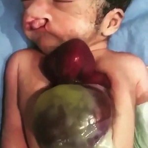 1.4K views · 21 reactions | ECTOPIA CORDIS La ectopia cordis es una...