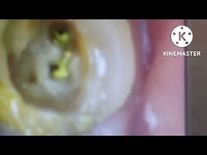 how to do ReRCT with metapex