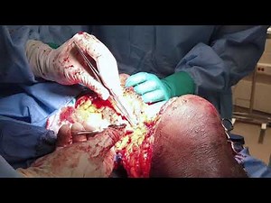 Above Knee Amputation